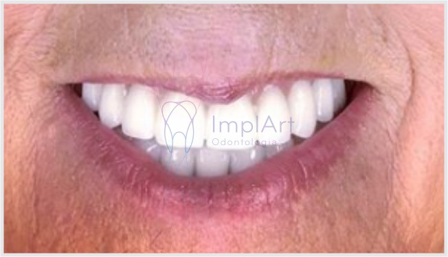Implantes dentário antes e depois