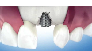 rejeição-de-implante-dentario