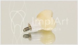 Coroa zirconia implante dentario 40kb
