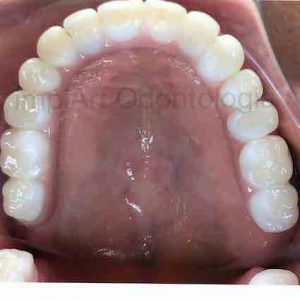 protese dentaria de zirconia