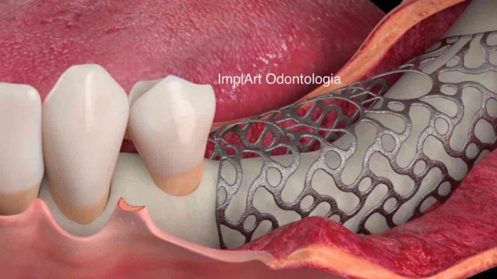 O Que É O Enxerto Ósseo Dentário? – NAVTFV