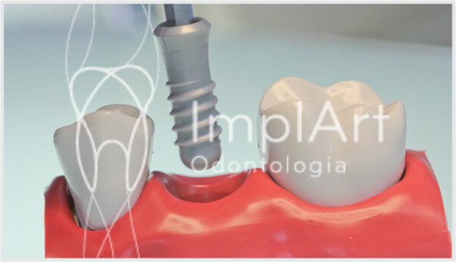 Complicações / erros e falhas em implantes dentários