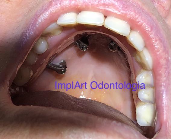implante zigomatico ceu da boca