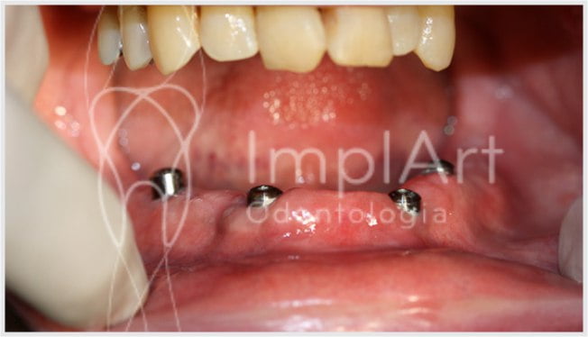 Eventuais motivos de reclamação em tratamento com implante dentário