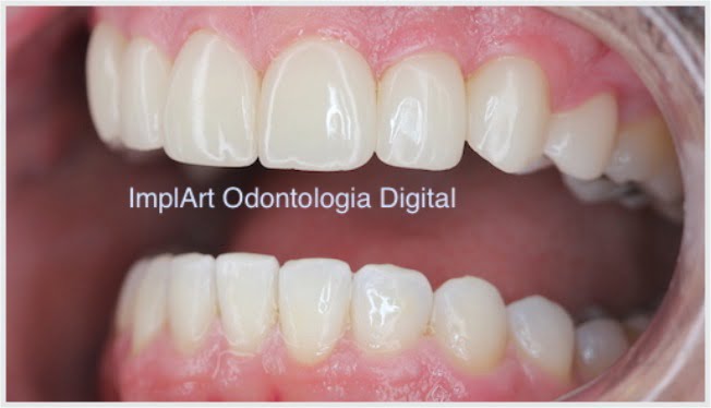 reabilitação oral superior dentes individuais porcelana 50kb