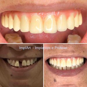 implante_dentario_antes_depois