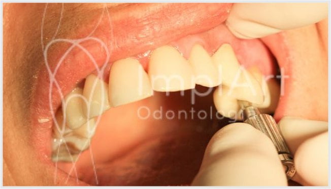 Carga rápida com implante dentário