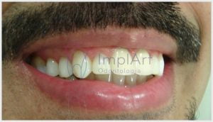 carga rapida para implantes dentes individuais 45kb