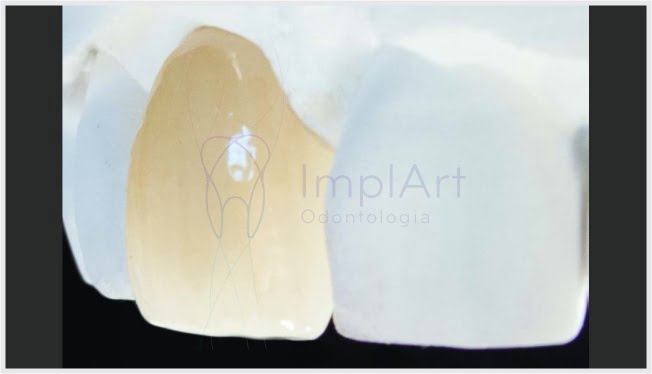 Implante de zircônia: o implante dentário de cerâmica