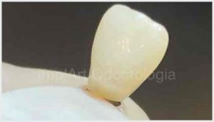 coroa de zirconia translucida para implante 45kb