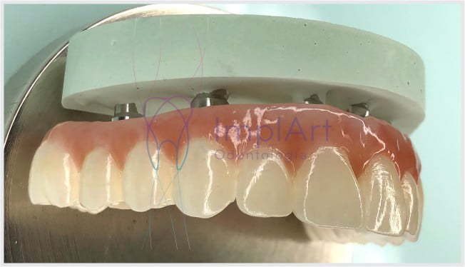Album de fotos – Implante dentário e estética dental – ImplArt