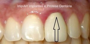 inflamação prótese dentária