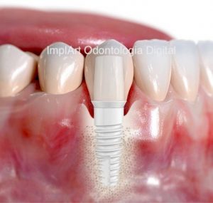 implante dentario branco sem metal
