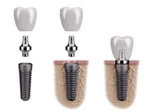 procedimento de implante dentario, implante dental