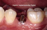 quanto custa implante dentario