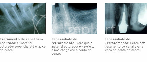 tratamento_de_canal_implante