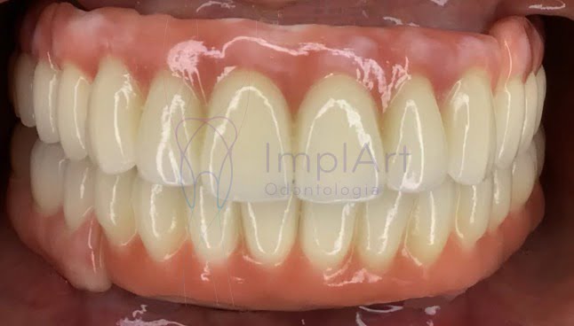 Implante dentário protocolo com fotos