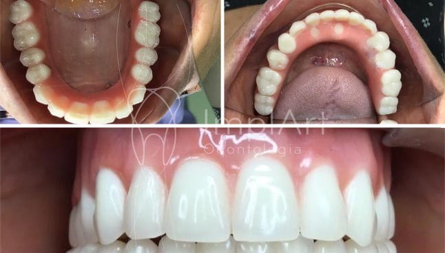 Dúvidas sobre prótese dentária protocolo sob implante dental