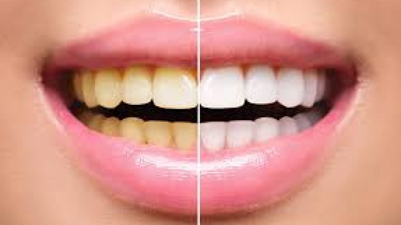 Maneiras simples de clareamento natural dos dentes funcionam?