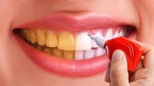 clareamento dental 2