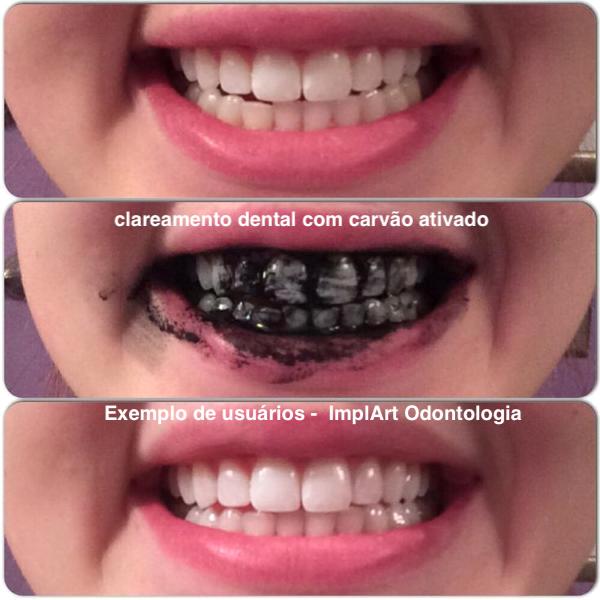 clareamento dental com carvao