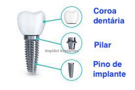 partes de um implante dentario