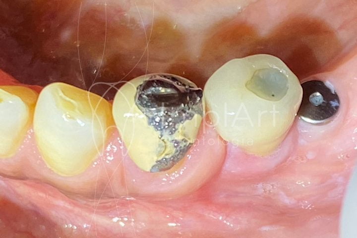 durabilidade da prótese dentária metalocerâmica