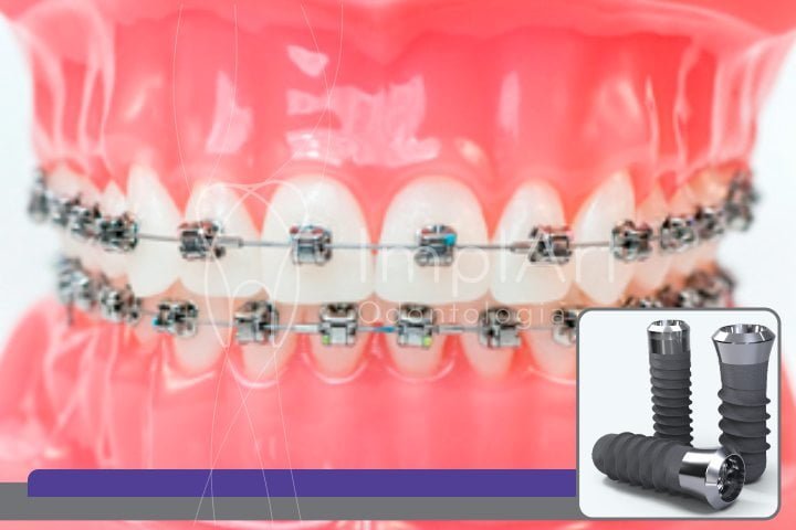 Implante dentário em quem usa aparelho ortodôntico