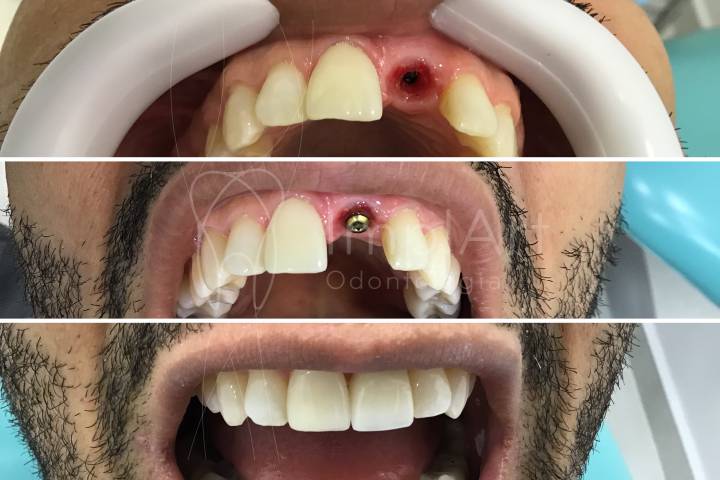 implante dentario unitario 50kb