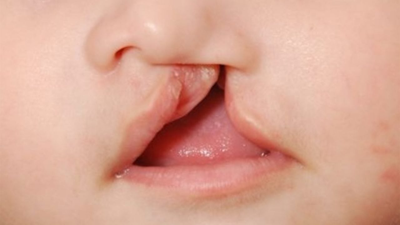 Lábio leporino e implantes dentários para substituir dentes - Blog ImplArt