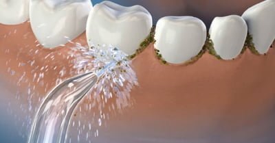 Irrigador dental é um aliado da boa higiene oral para implantes