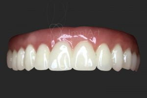 protese dentaria total fixa implantes zirconia 50kb