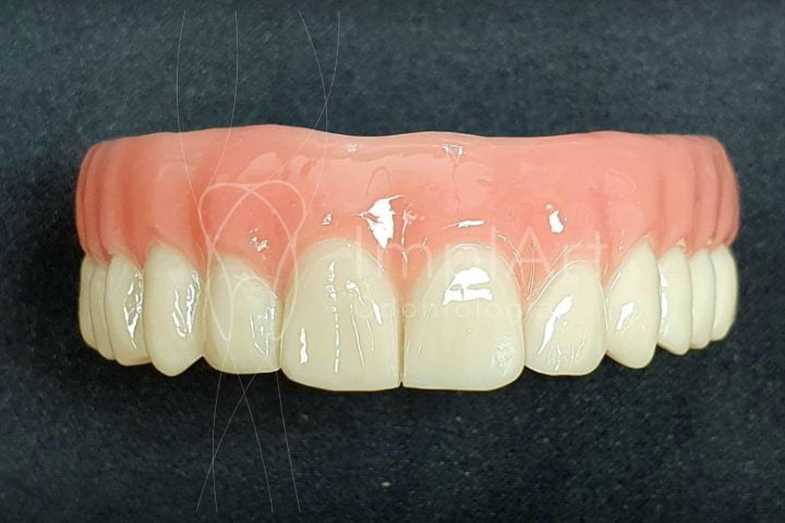 protese dentaria total implante de todos os dentes