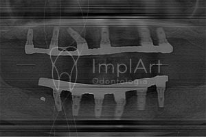reabilitacao oral completa protese fixa implantes metaloplastica 1 50kb