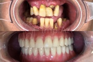 reabilitacao oral completa protese fixa implantes metaloplastica 50kb