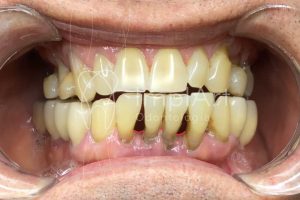 blackspace doenca periodontal 50kb