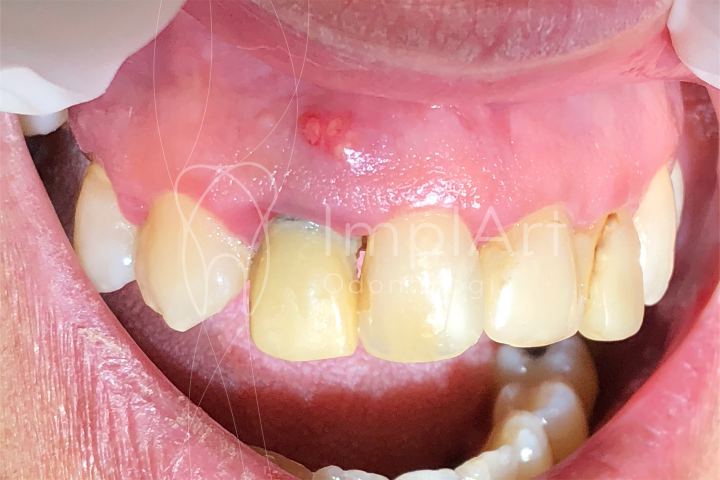 Fístula dental pús