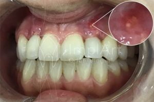 fistula dental 50kb