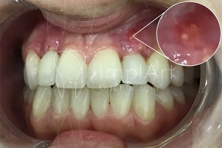 fistula dental 50kb