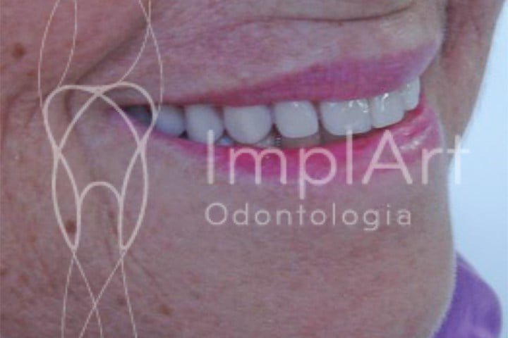 Implante dentário para a boca toda 