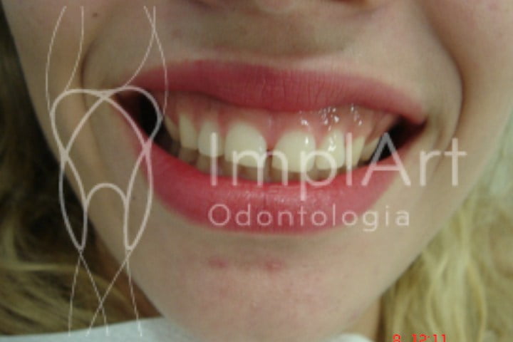 Diastema dental 44kb