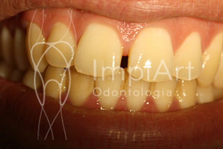 Diastema dental 45kb