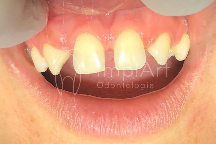 Diastema dental 46kb