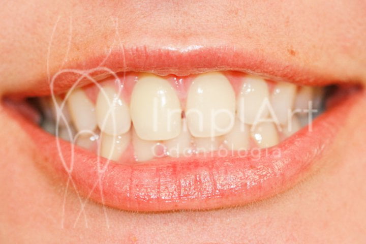 Diastema dental 50kb