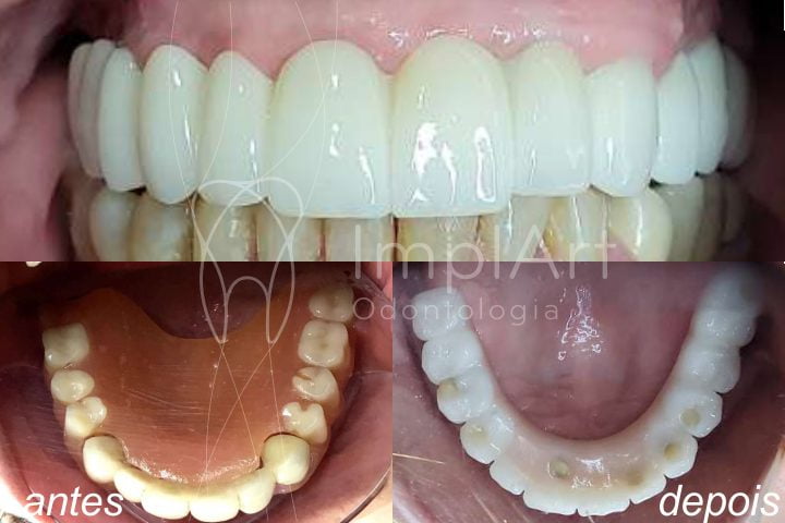 Troca_protese_movel_protese_total_sobre_implantes_50kb - Clínica ...