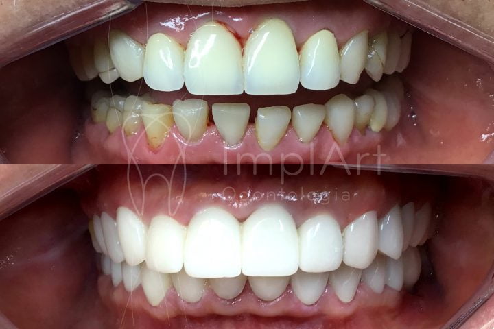 lente contato dental antes e depois 50kb