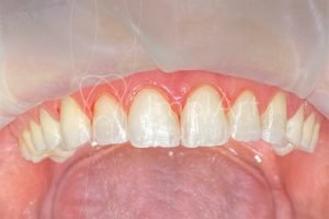 preparo_desgaste_dentes_para_lentes_ dentes humanos