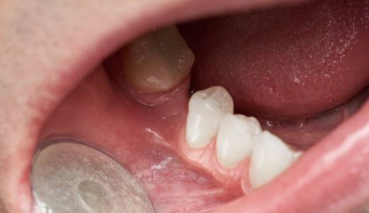 implantes nos dentes do fundo 1 falta de um dente