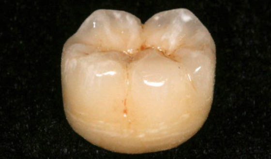 implantes nos dentes do fundo 3 coroa dentaria