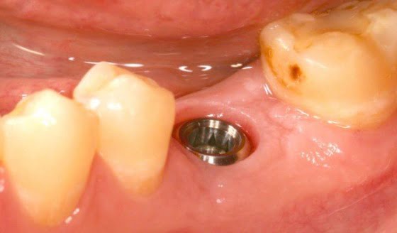 implantes nos dentes do fundo 5 - implante e gengiva
